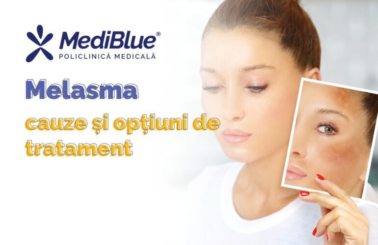 Melasma – Cauze și Opțiuni de Tratament