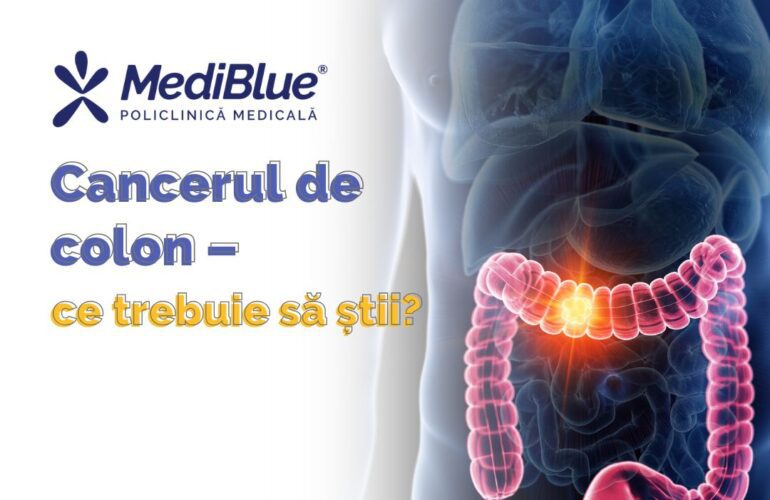 cancerul de colon